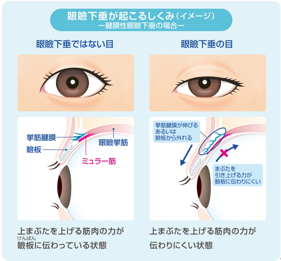 眼瞼下垂が起こるしくみ 眼瞼下垂が起こるしくみ