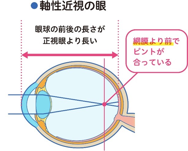 軸性近視の眼 軸性近視の眼.jpg