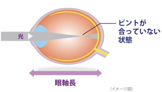 軸性近視の眼